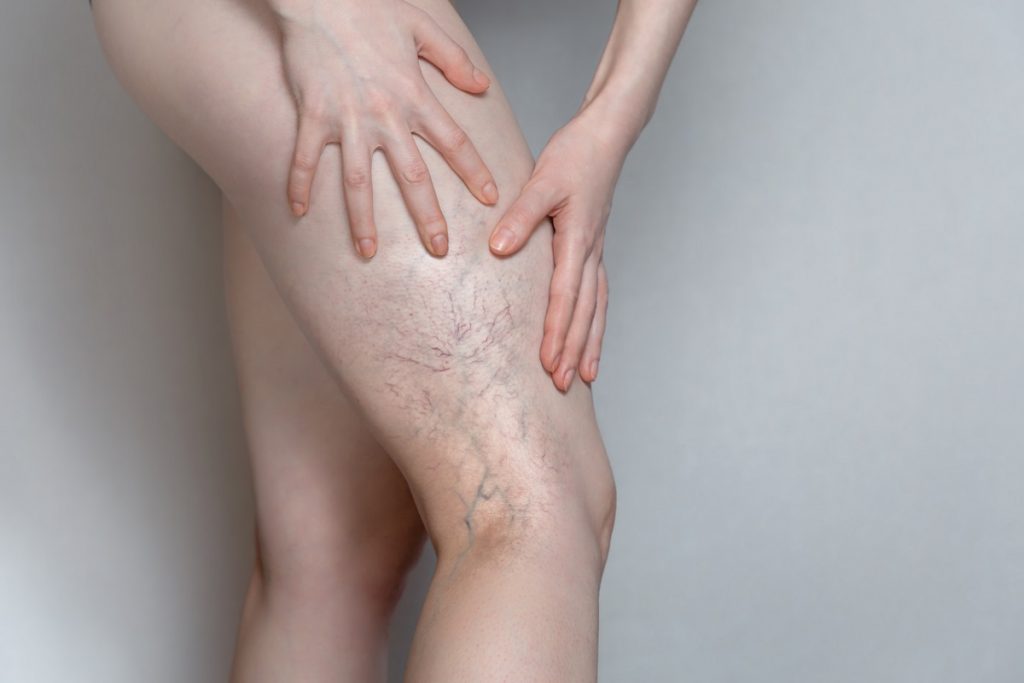 Varices et insuffisance veineuse Jambe Femme