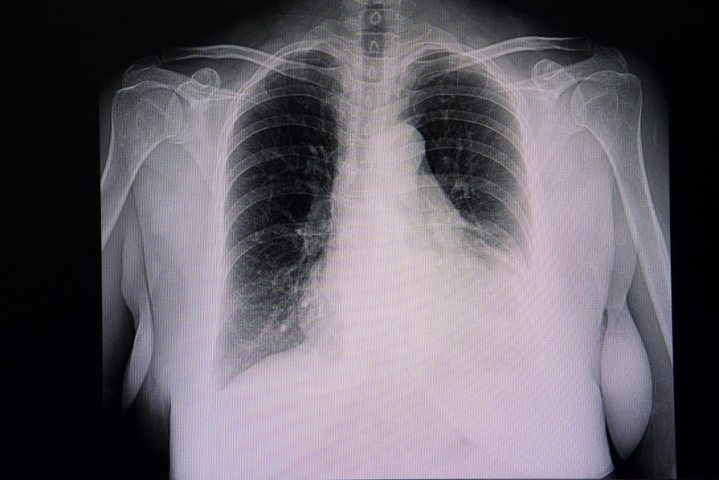 Épanchement pleural : radiographie