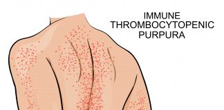 Purpura thrombopénique immunologique