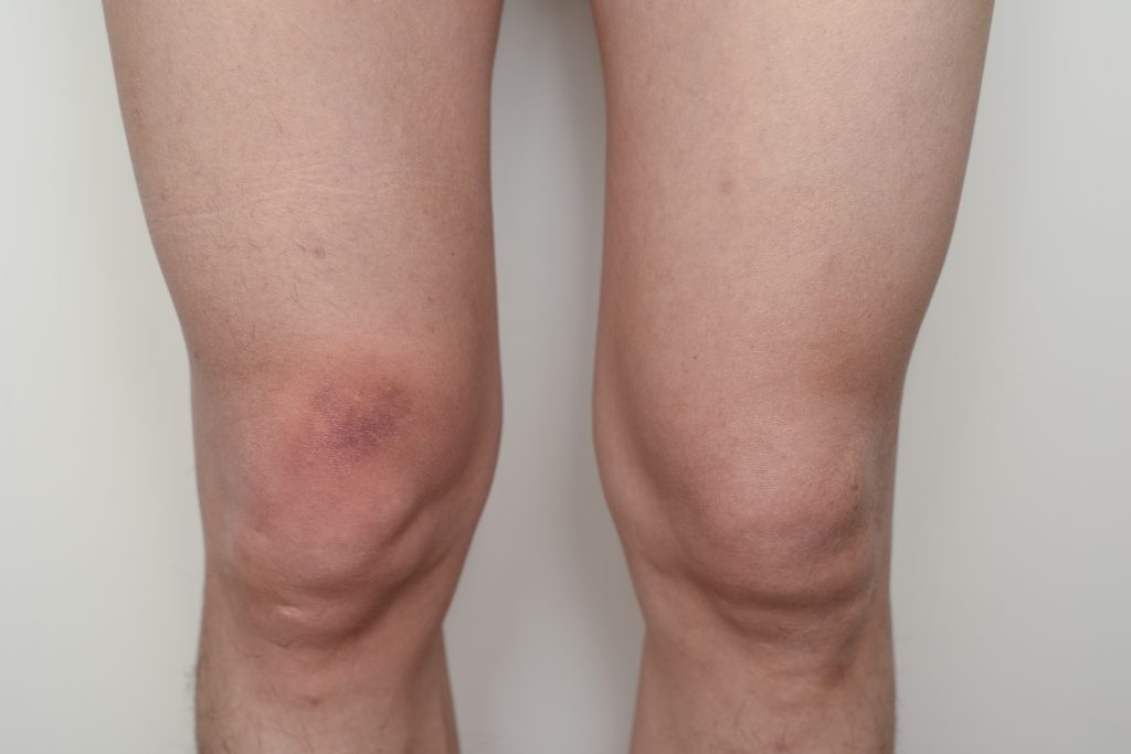 Purpura aux genoux