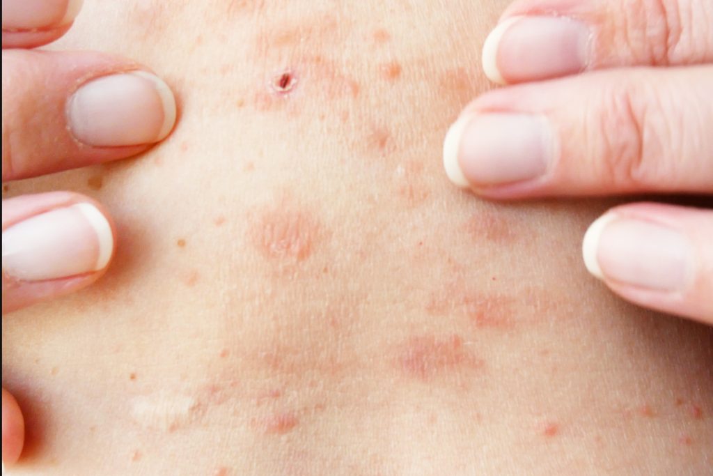 zona varicelle infection photo