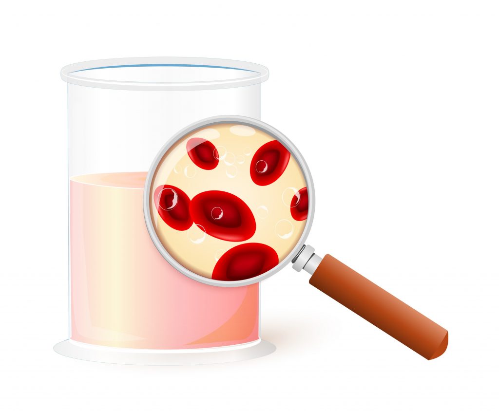 hématuria : sang urine