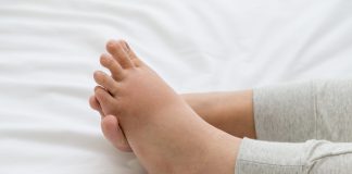 Syndrome œdémateux : pied gonflé