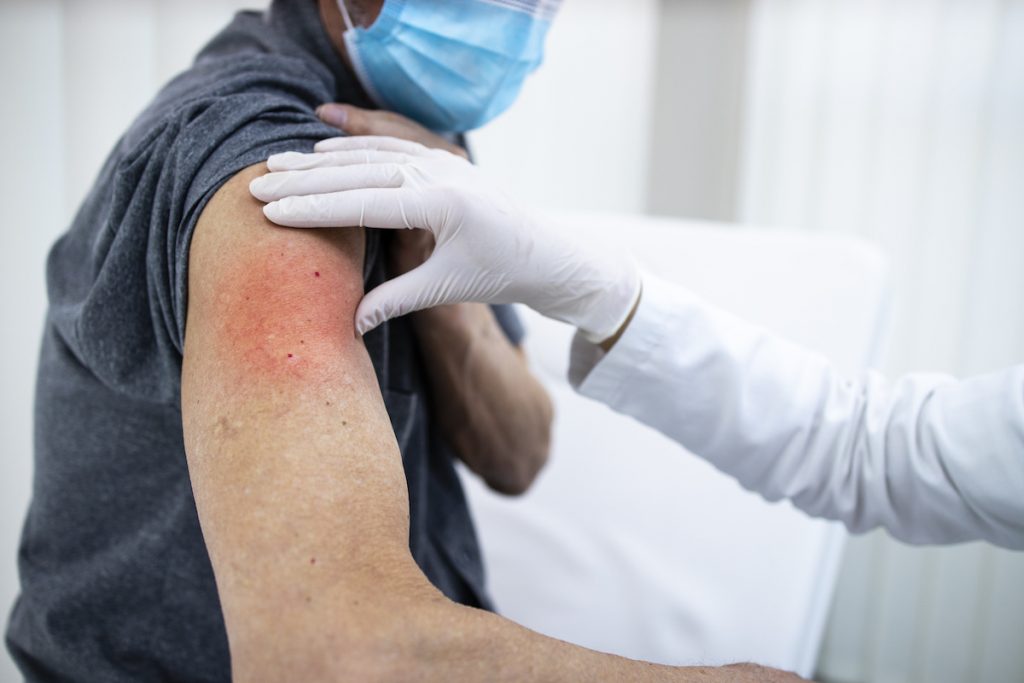 Effets indésirables après vaccin covid sur le patient