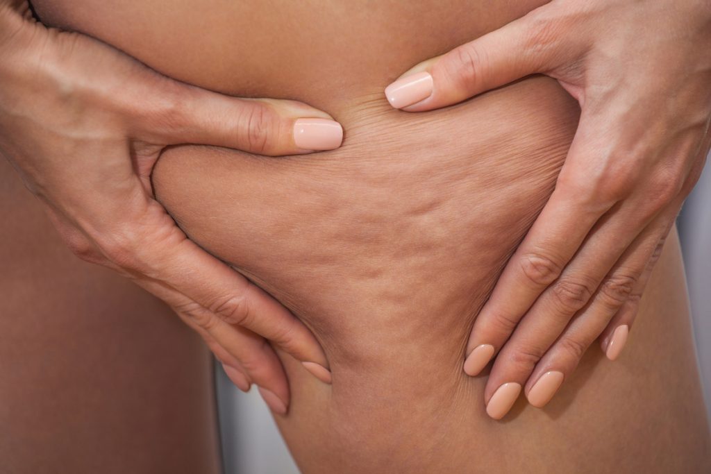 Cellulite : comment la faire disparaître ? Cellulite : comment la faire disparaître ?