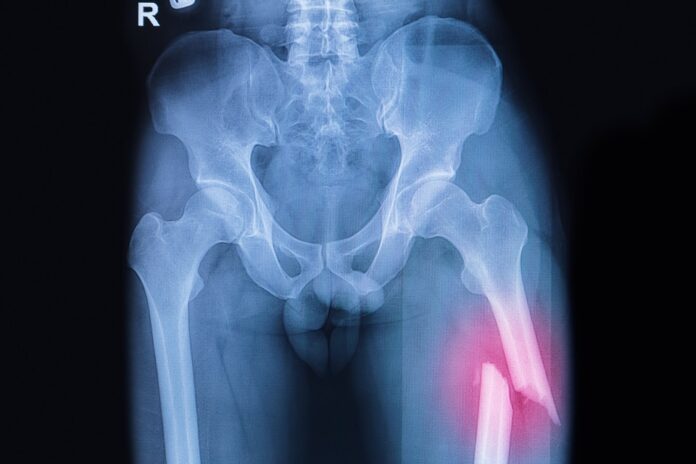 Fracture du col fémoral Fracture du col fémoral : radio