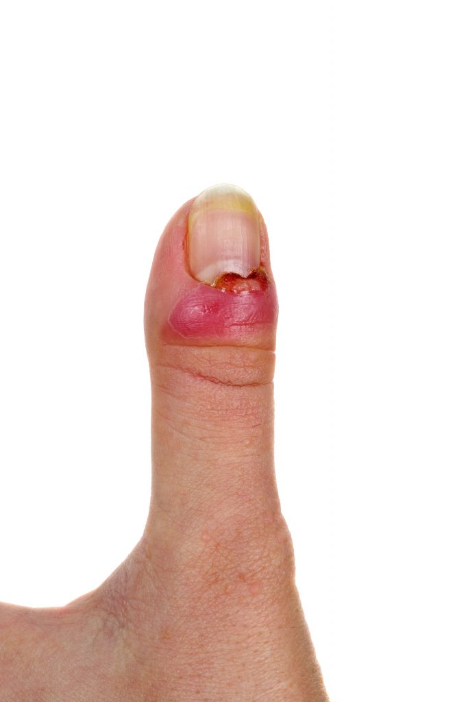 Panaris Panaris photo