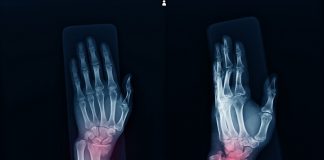 Fracture du Radius : Radiologie