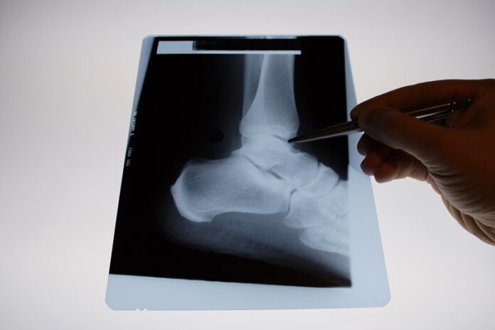 Les pathologies méniscales Pathologie Méniscale : radio