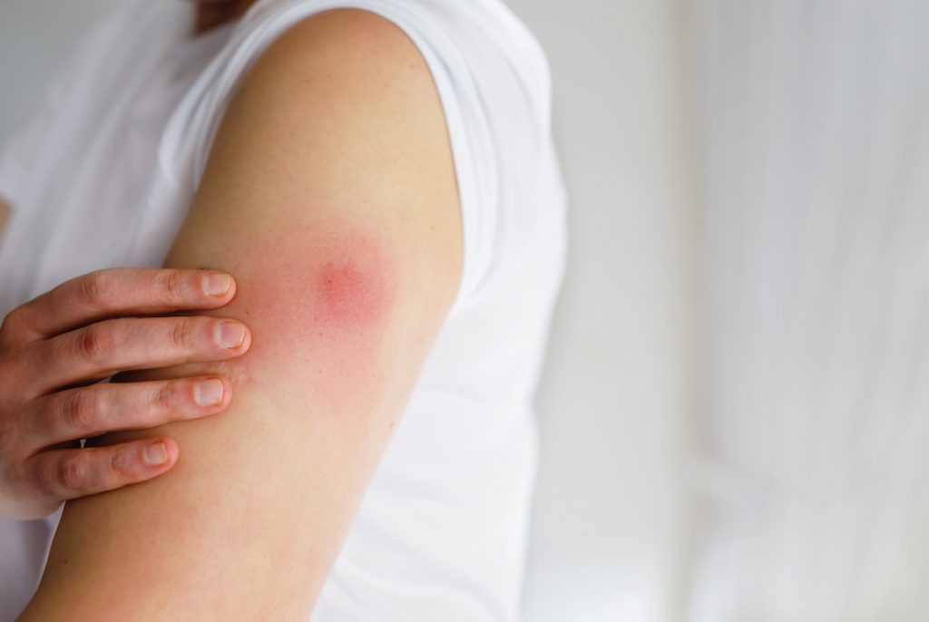 Vaccination Covid : comment déclarer un effet indésirable ?