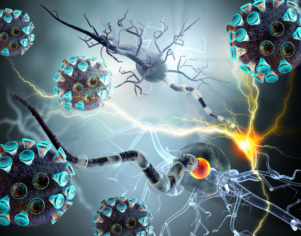 Covid-19 : séquelles neurologiques de type Alzheimer