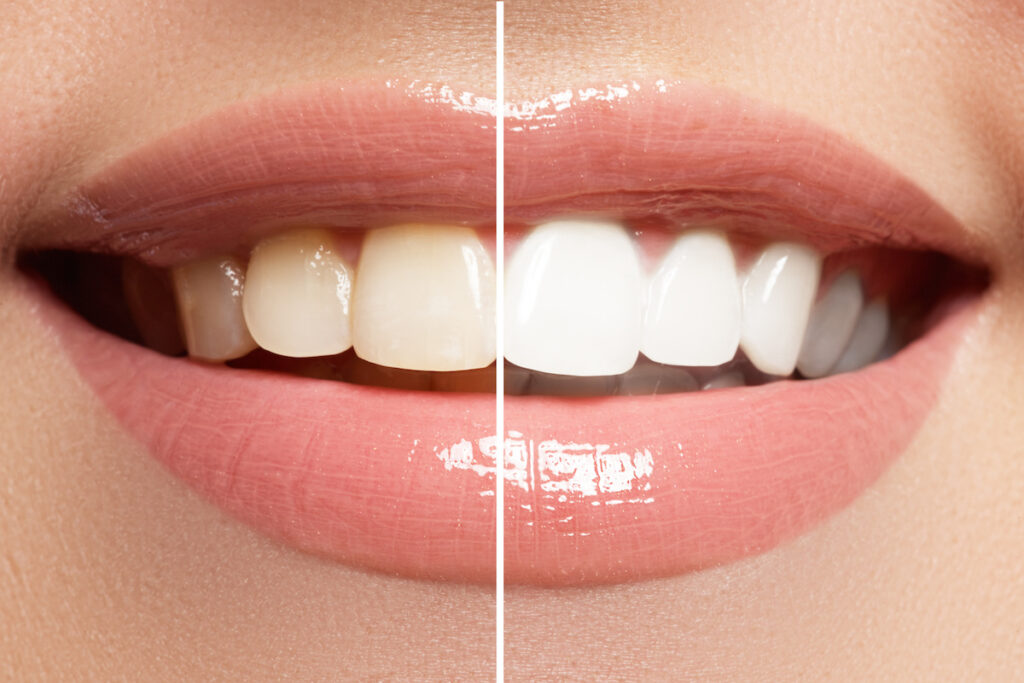 comment garder des dents blanches