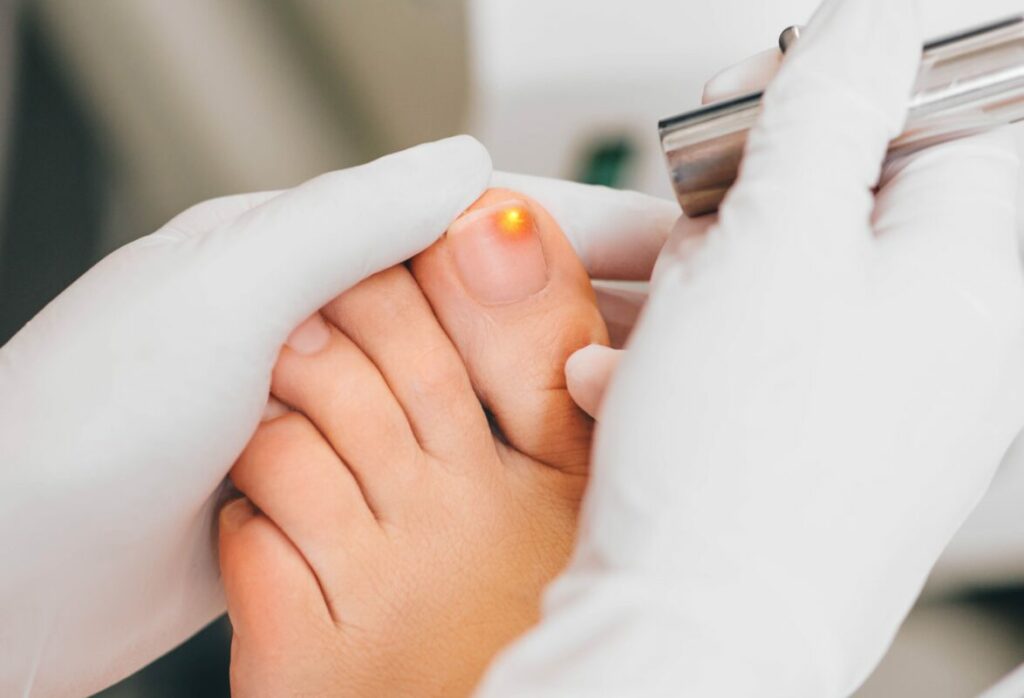 Mycose de l’ongle de pied : diagnostic, symptômes et traitement mycose ongle pied
