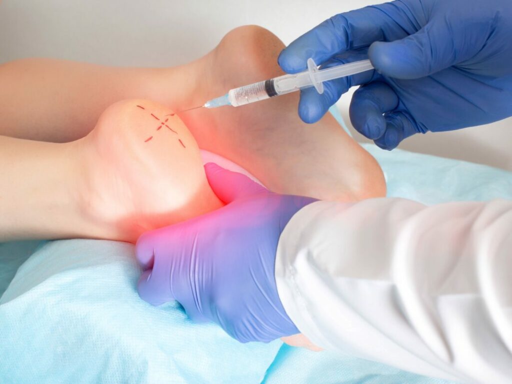 operation epine calcanéenne