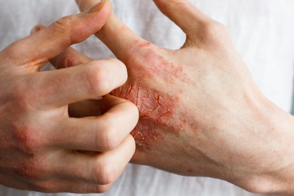eczema nerveux