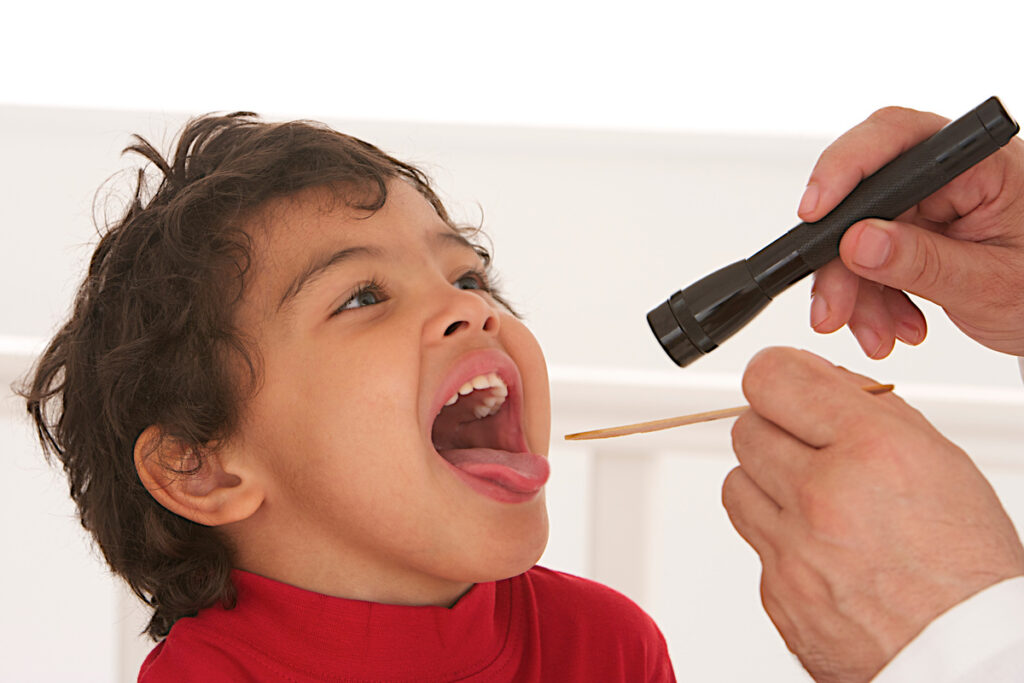 Amygdale gonflée : cause et traitement amygdale gonflée