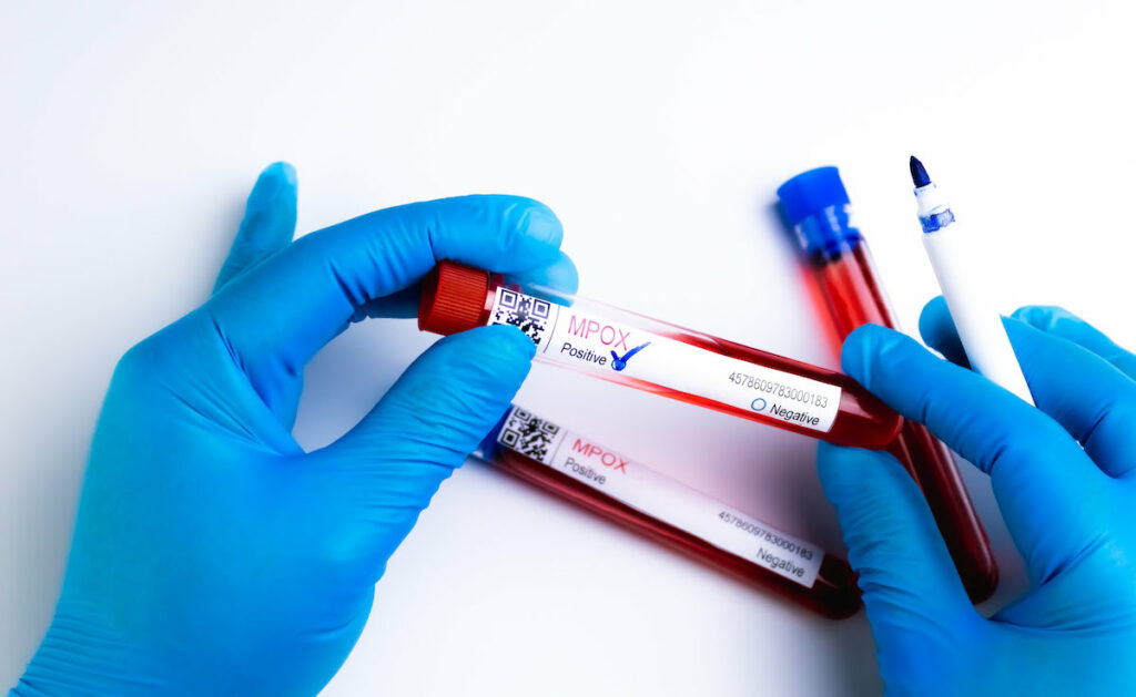 Variole du singe : une forme mortelle identifiée chez certains patients