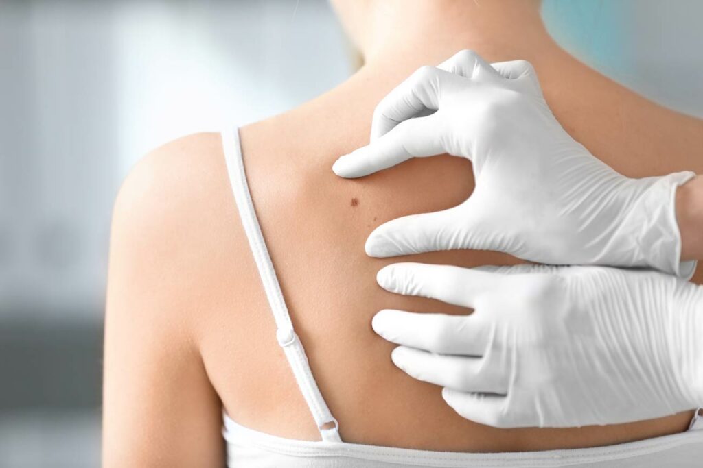 Cancer : Grain de beauté suspect, quand faut il s'inquiéter ?