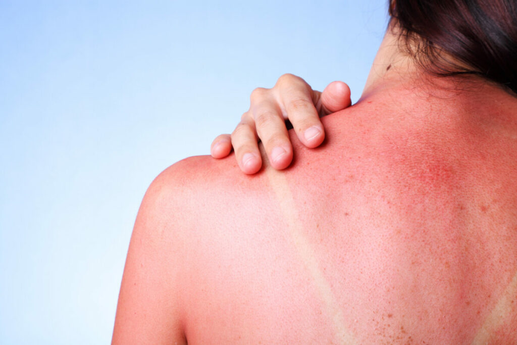 Coup de soleil 5 astuces naturelles pour le soulager