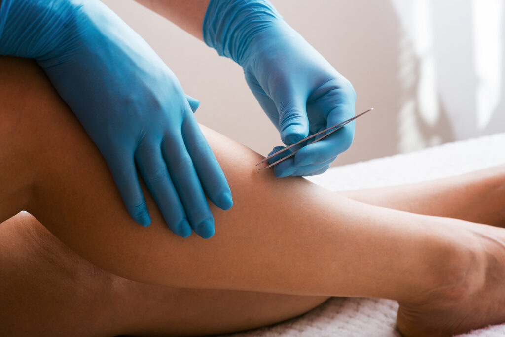 Poils incarnés : solutions naturelles pour en venir à bout