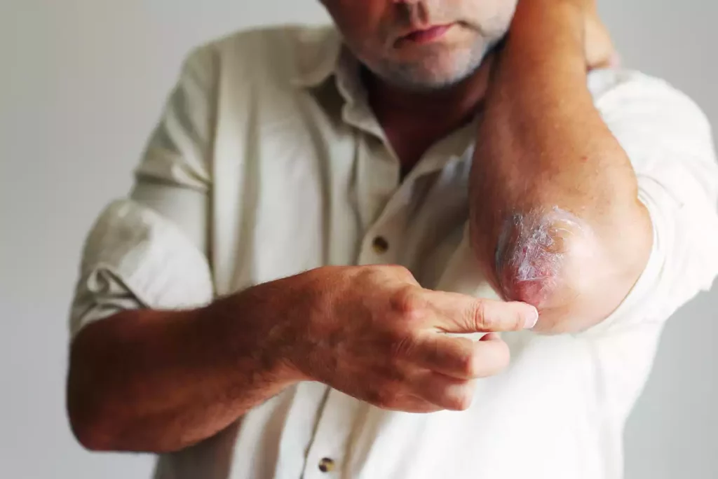 Plaques rouges sur le corps ? Et si c’était le psoriasis ?