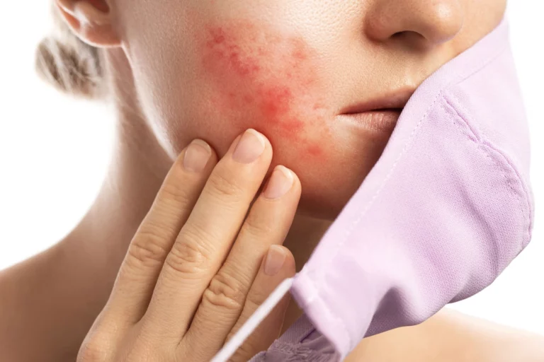 Allergie aux anti-inflammatoires non stéroïdiens ! Quels sont les signes annonciateurs à reconnaître ?