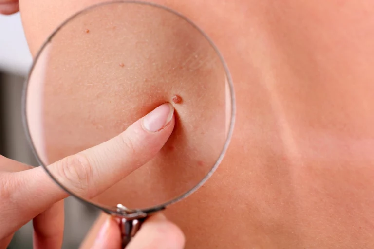 Grains de beauté : la méthode ABCDE pour repérer ceux qui peuvent être dangereux grains de beauté